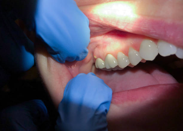 Best Dental Abscess Treatment in Madison, SD